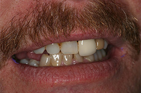 Smile Before Treatment
