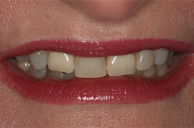 Smile Before Treatment