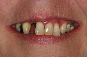 Smile Before Treatment
