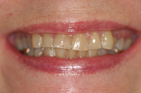 Smile Before Treatment