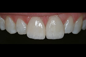 Smile After Treatment