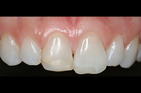 Smile Before Treatment