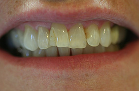 Smile Before Treatment